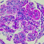 Autoimmune field buoyed by successes with CAR-T treatments