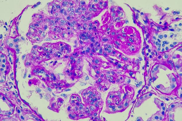 Autoimmune field buoyed by successes with CAR-T treatments