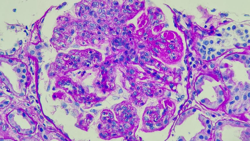 Autoimmune field buoyed by successes with CAR-T treatments