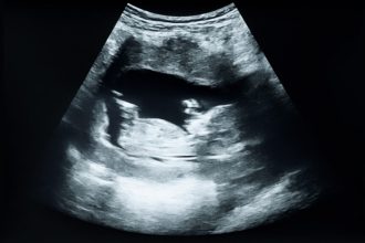 Iran war public health, C-section rates: Morning Rounds