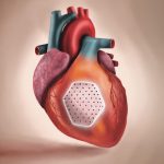 BioVAT stem cell heart patch offers hope for heart failure patients