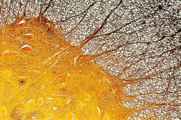 Immune Cell Discovery Might Explain Multiple Sclerosis at Its Worst : ScienceAlert