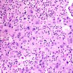 Merck-Kelun lung cancer drug cut tumor progression risk by 65%