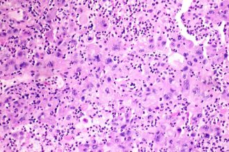 Merck-Kelun lung cancer drug cut tumor progression risk by 65%