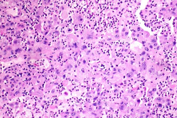 Merck-Kelun lung cancer drug cut tumor progression risk by 65%