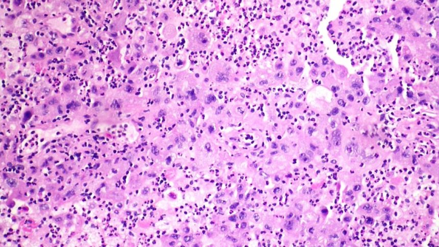 Merck-Kelun lung cancer drug cut tumor progression risk by 65%