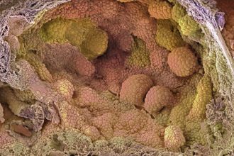New hormone protocol cut relapse risk in prostate cancer trial