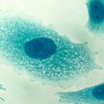 Study: PSA tests likely reduce risk of death from prostate cancer