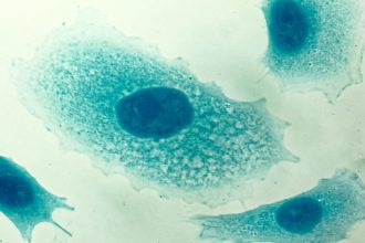 Study: PSA tests likely reduce risk of death from prostate cancer