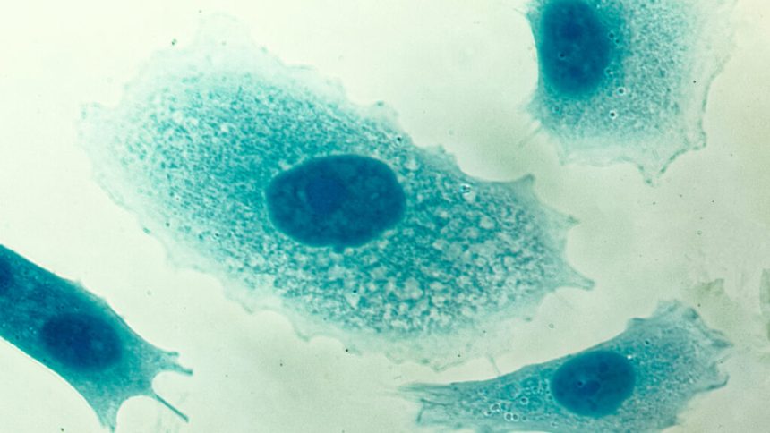 Study: PSA tests likely reduce risk of death from prostate cancer
