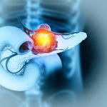 A New Way To Hit Pancreatic Cancer’s Hardest Target