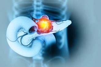 A New Way To Hit Pancreatic Cancer’s Hardest Target