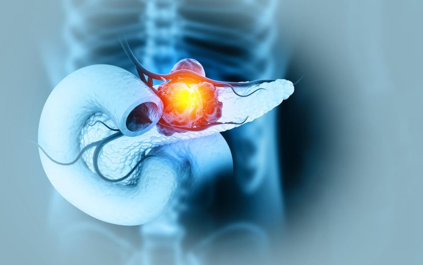 A New Way To Hit Pancreatic Cancer’s Hardest Target