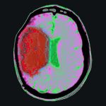 Chilling the body with drugs could limit brain damage from stroke