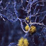 Huge study of Alzheimer’s genetics identifies new drug targets