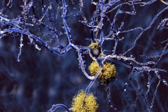 Huge study of Alzheimer’s genetics identifies new drug targets