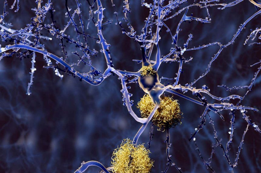 Huge study of Alzheimer’s genetics identifies new drug targets