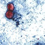 Cyclospora now in 29 states, more than 1,000 cases reported