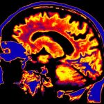 Scientists Discover a Potential Driver of Chronic Fatigue Syndrome Hiding Deep in The Brain : ScienceAlert