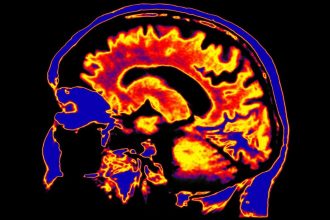 Scientists Discover a Potential Driver of Chronic Fatigue Syndrome Hiding Deep in The Brain : ScienceAlert