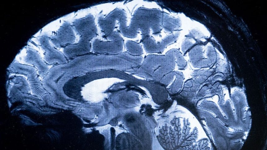 Scientists Witness Remarkable Brain Cell ‘Takeover’ in Midlife : ScienceAlert