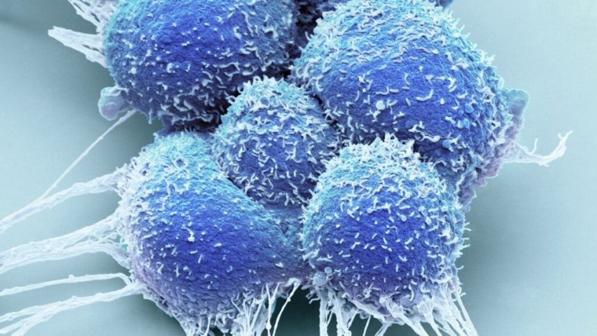 Science, risks and data behind focal therapy for prostate cancer